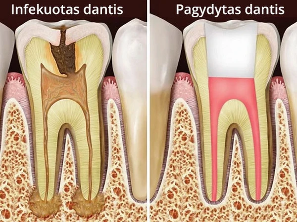 Profesionalus dantų kanalų gydymas Vilniuje
