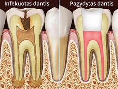 Dantų kanalų gydymas