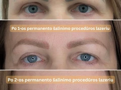 Profesionalus Permanentinio makiažo šalinimas Lazeriu arba skysčiais